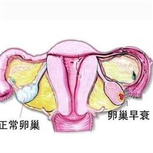 卵巢疾病