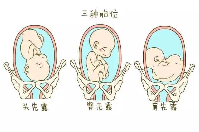 怀孕28周,胎儿臀位,胎位是不是固定了?还能转过来吗?
