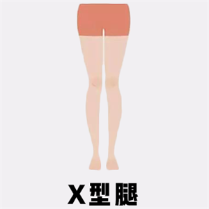 x型腿