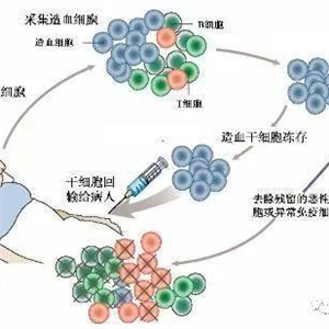 骨髓移植