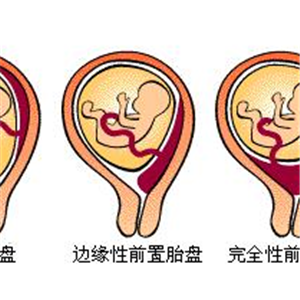 胎盘前置