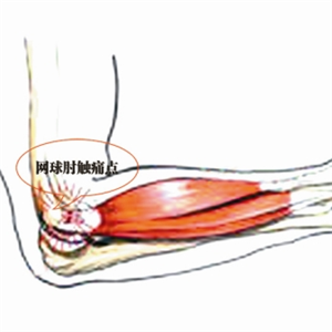 网球肘