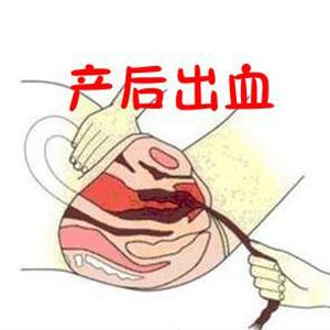 产后出血