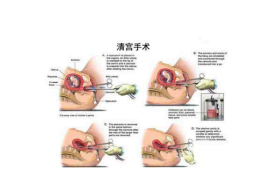 清宫手术