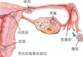 受精卵着床