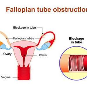 输卵管积水