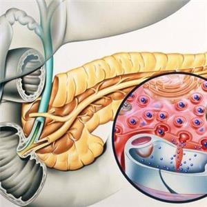 急性胰腺炎